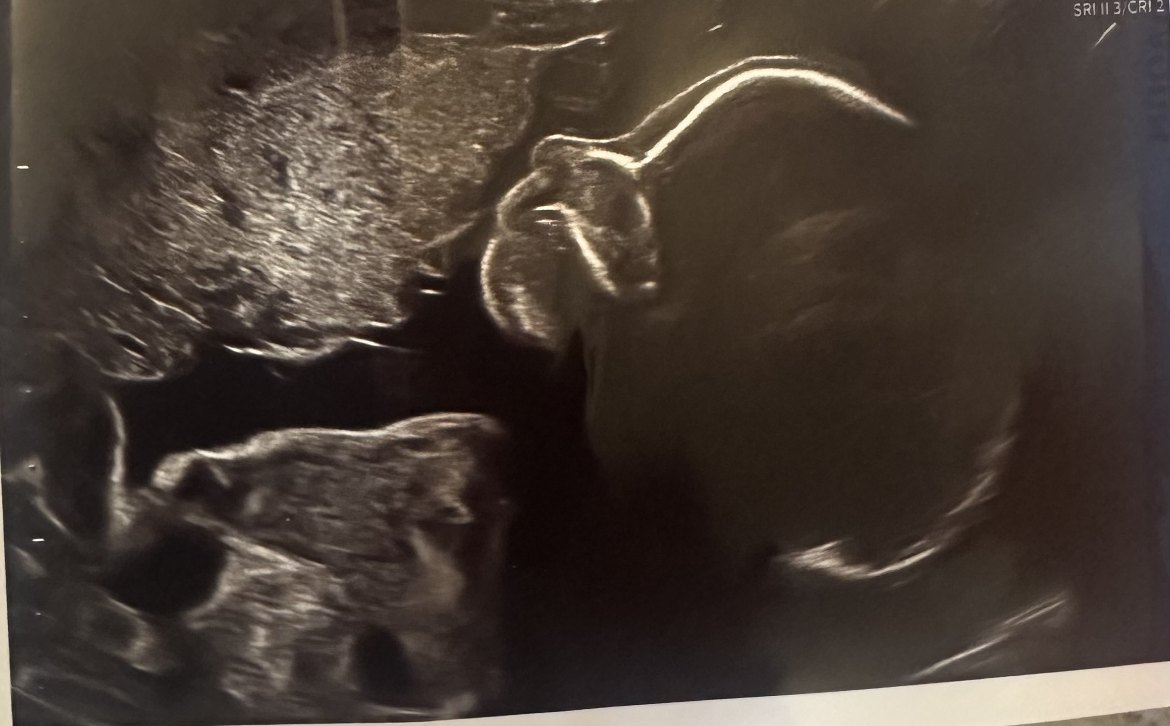 An ultrasound of our daughter